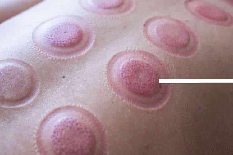 Cupping marks on the skin of the back